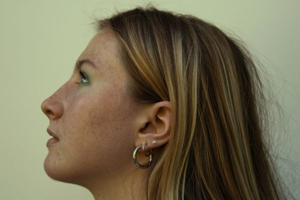 Top masseter reduction options for a defined jawline